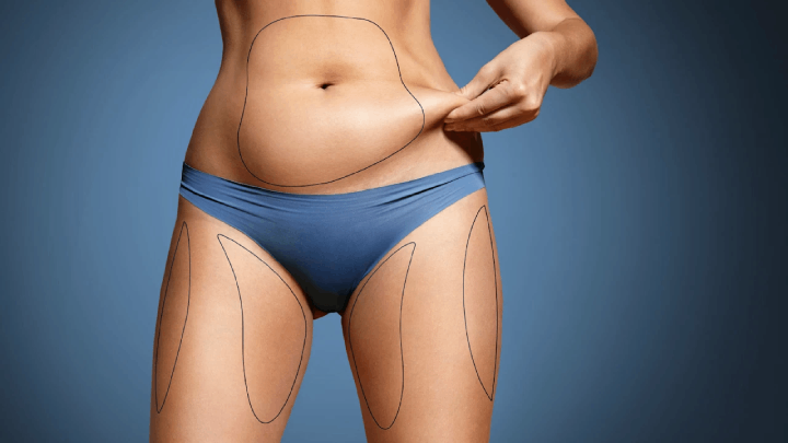 لیپوساکشن چیست