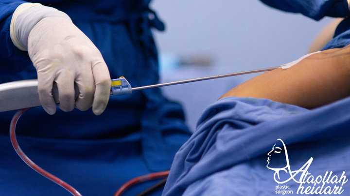 عوارض لیپوساکشن