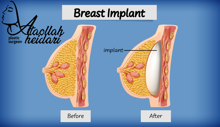 محل جاگذاری پروتز سینه