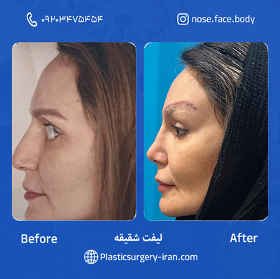 نمونه عمل لیفت شقیقه