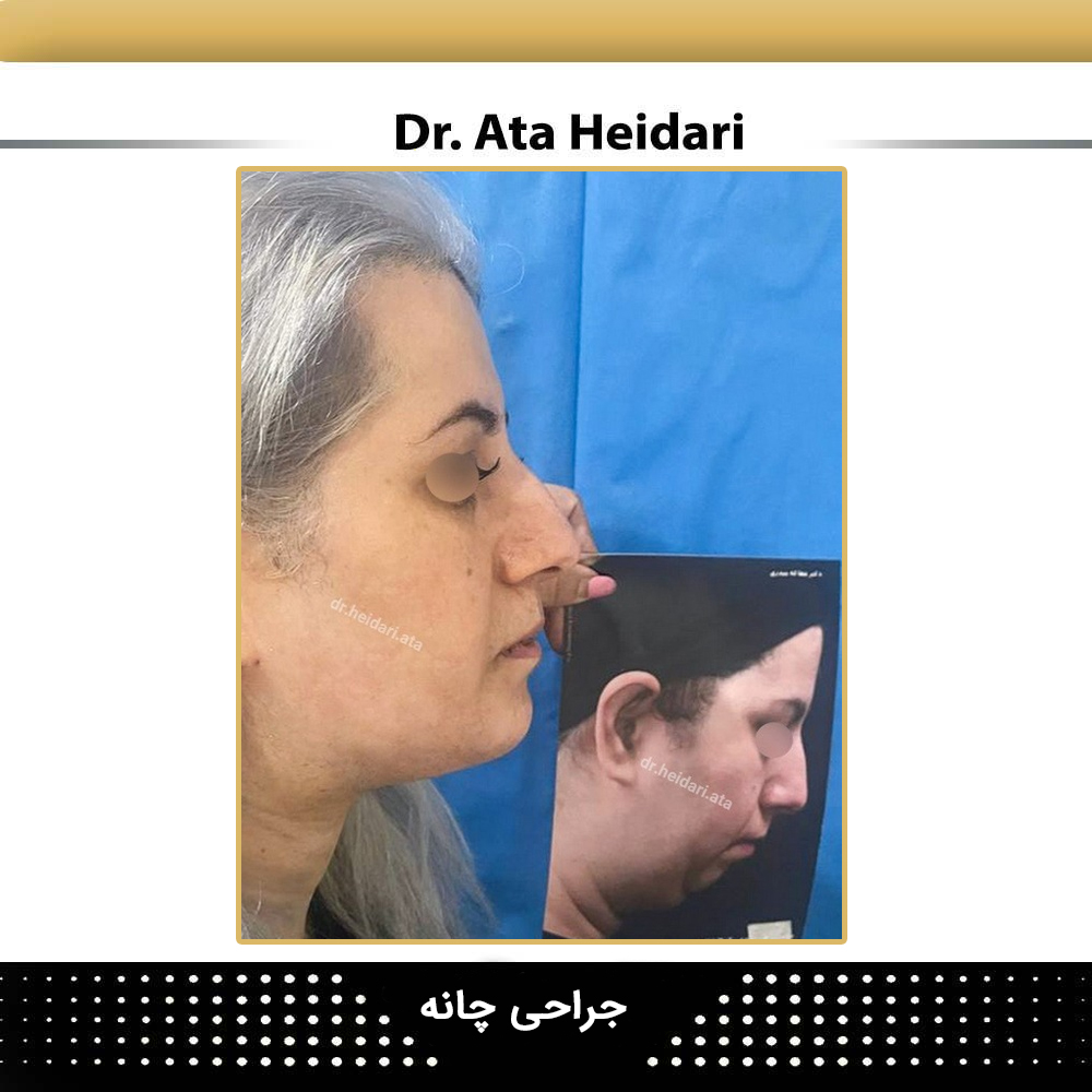 نمونه جراحی چانه 