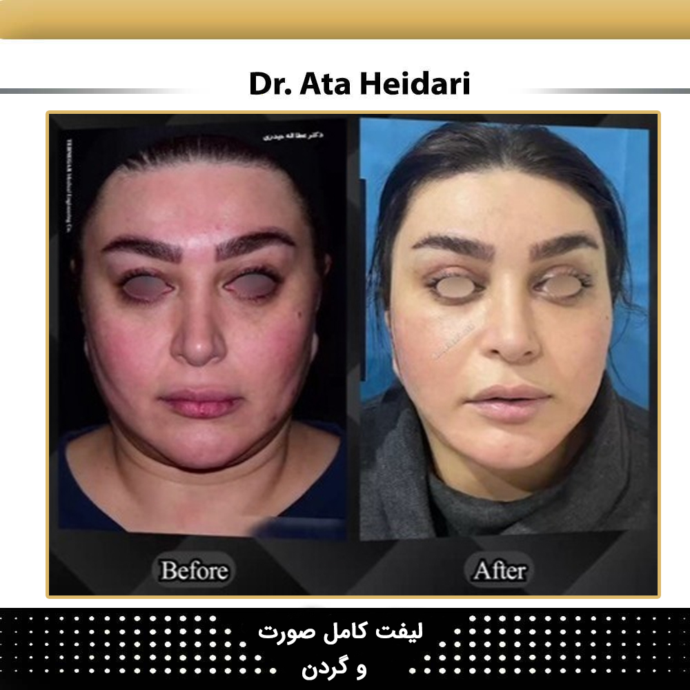 نمونه لیفت گردن