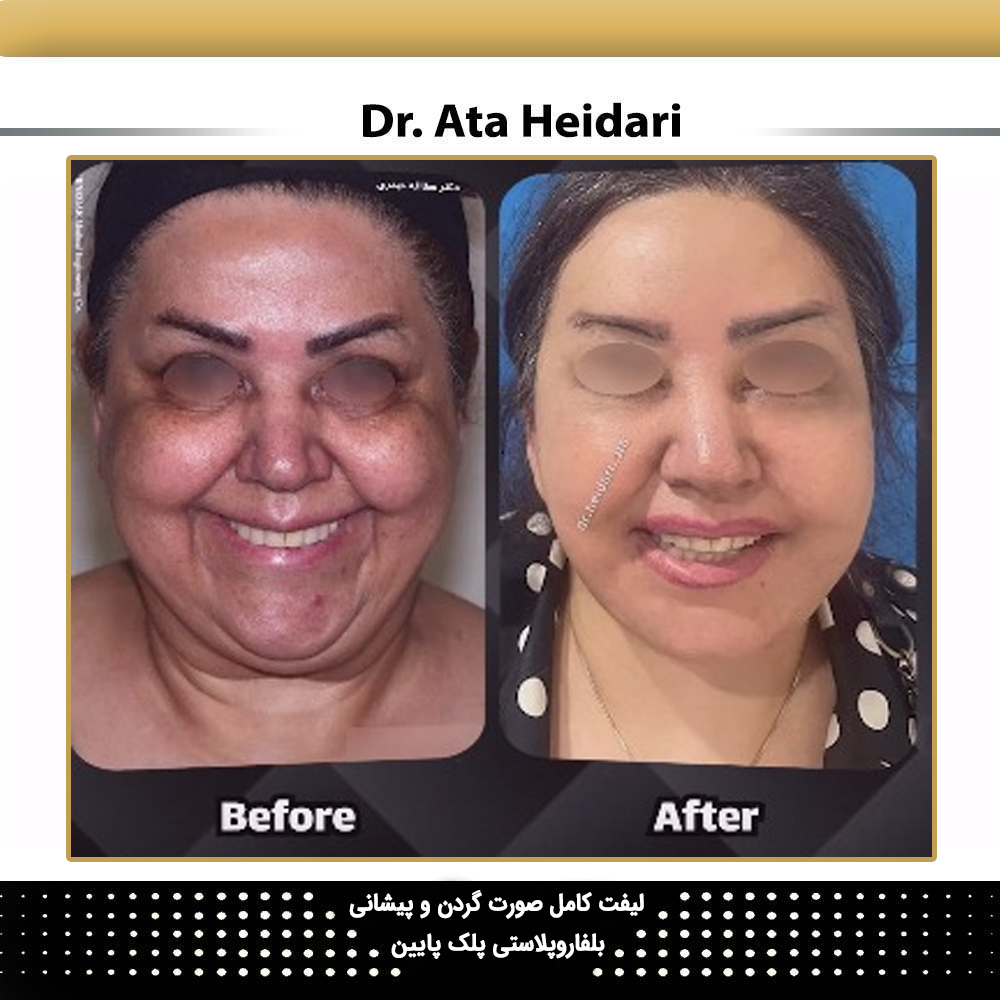 نمونه لیفت گردن