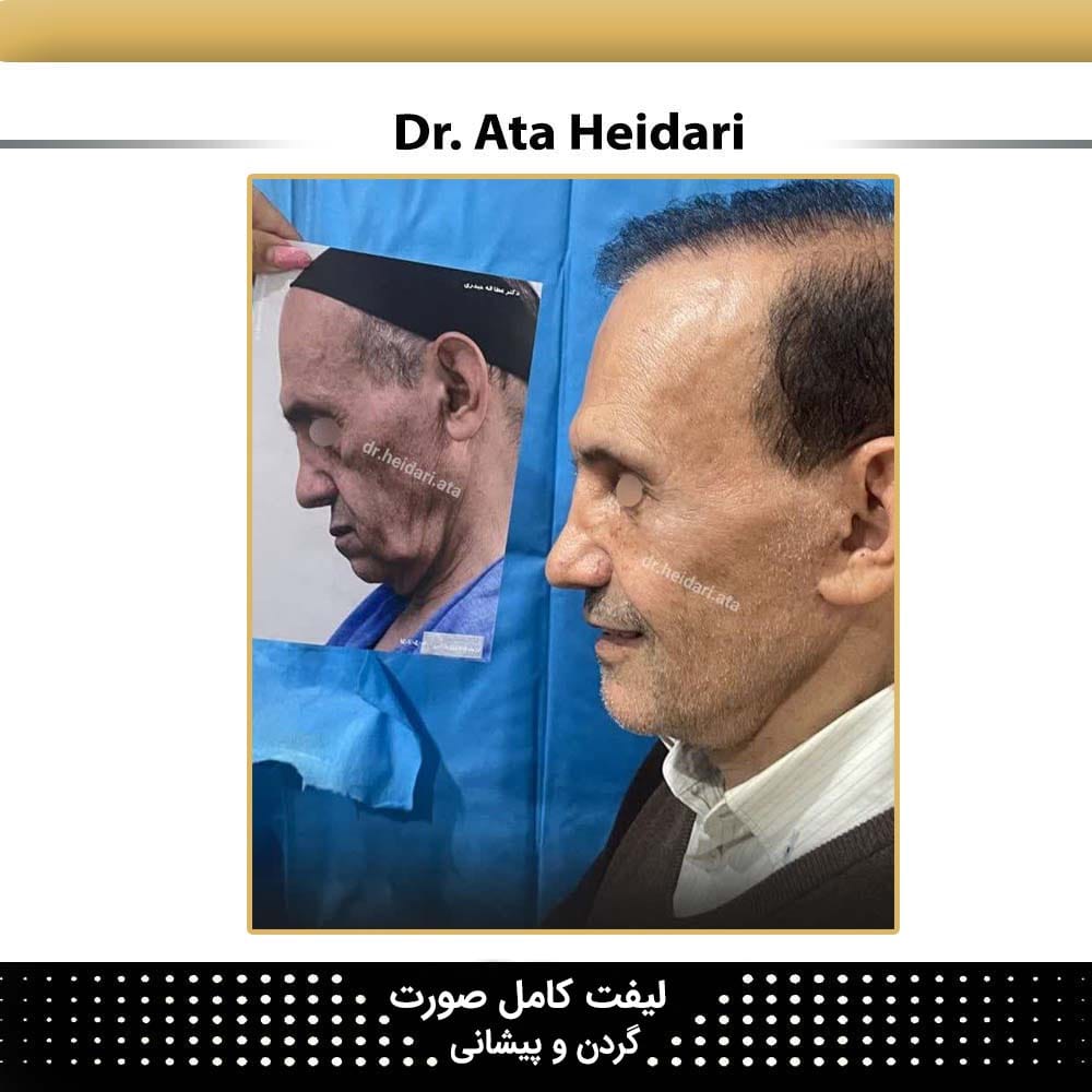 هزینه لیفت صورت