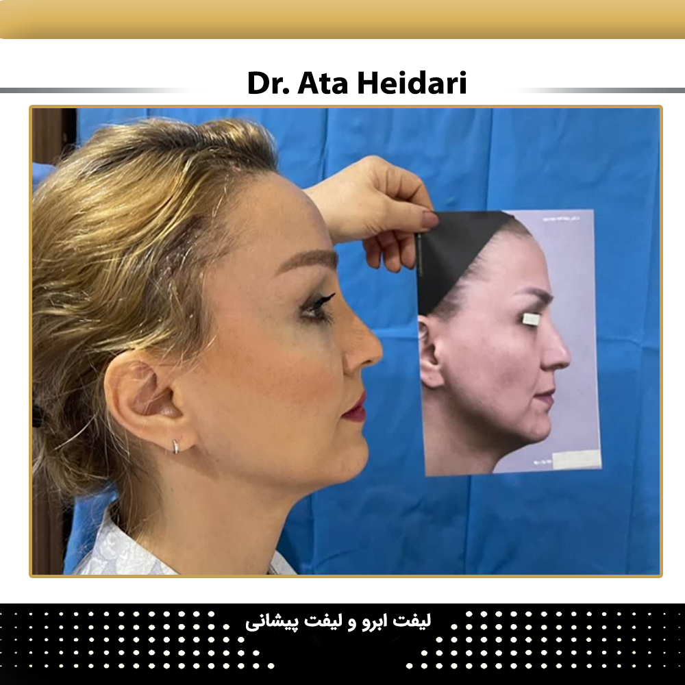 مزایای لیفت صورت