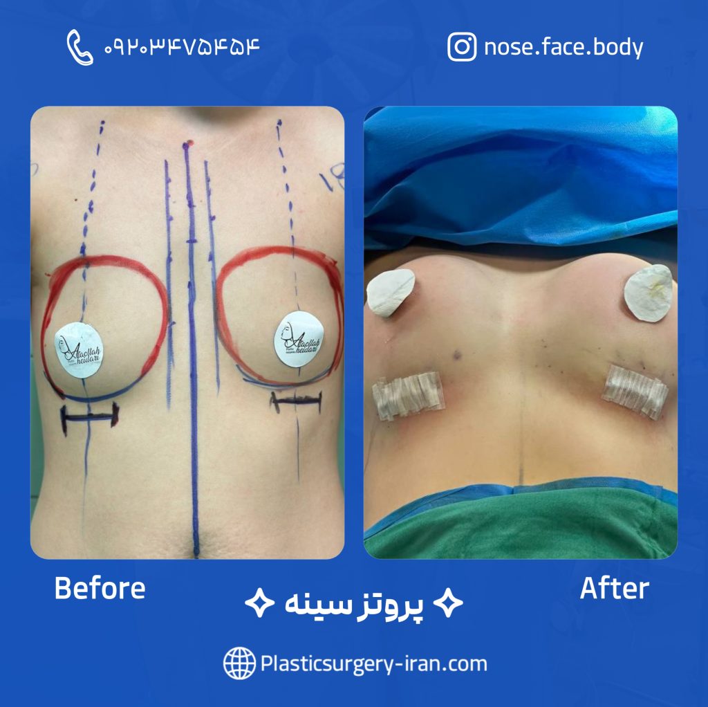 نمونه پروتز سینه