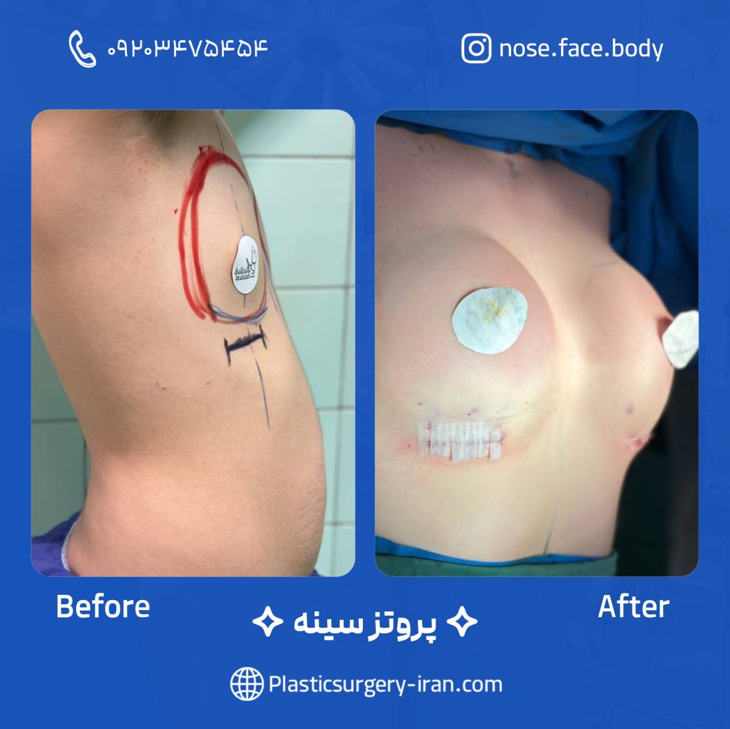قبل و بعد پروتز سینه