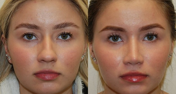 مراقبت های بعد از عمل بینی پهن و گوشتی