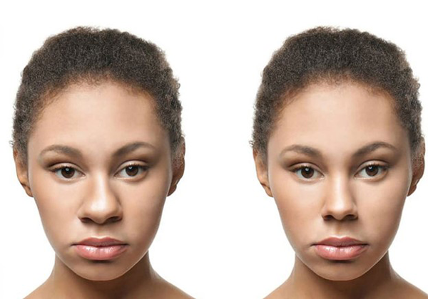  هزینه عمل بینی پهن و گوشتی