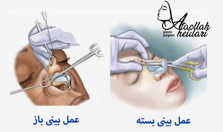 جراحی بینی به روش بسته 