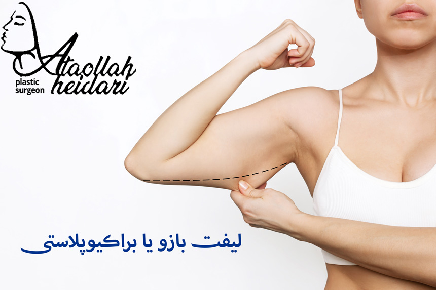 همه چیز در مورد لیفت بازو