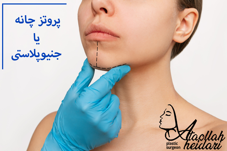 پروتز چانه یا جنیوپلاستی