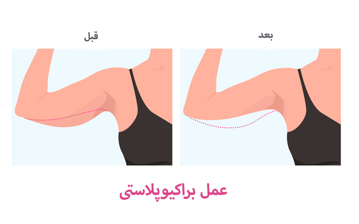 عمل لیفت بازو یا براکیوپلاستی چیست؟