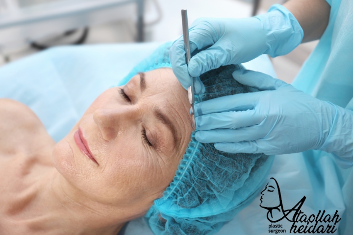 لیفت آندوسکوپی ابرو