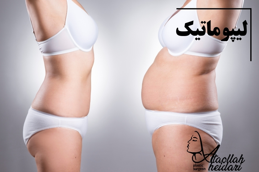 لیپوماتیک
