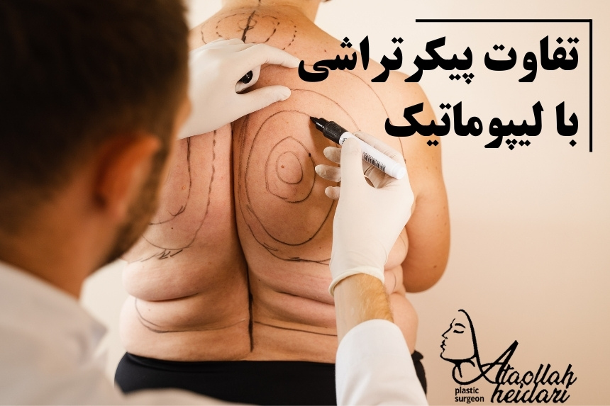 تفاوت پیکرتراشی با لیپوماتیک