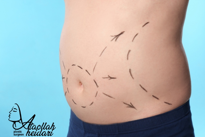 لیپوماتیک چیست؟