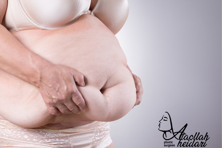 فرق ابدومینوپلاستی با لیپوماتیک چیست؟