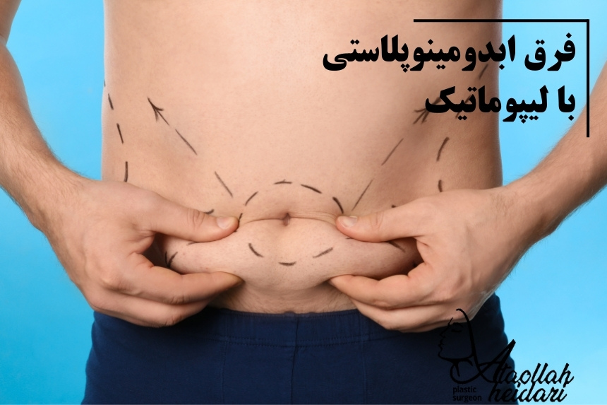 فرق ابدومینوپلاستی با لیپوماتیک