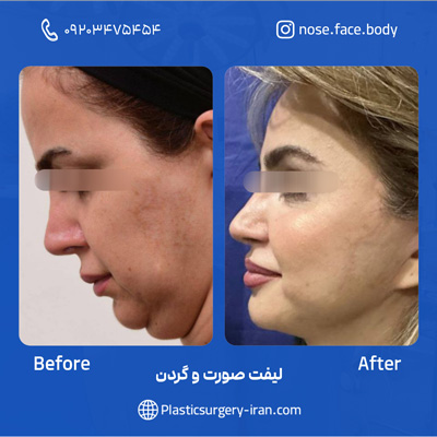 نمونه عمل لیفت صورت