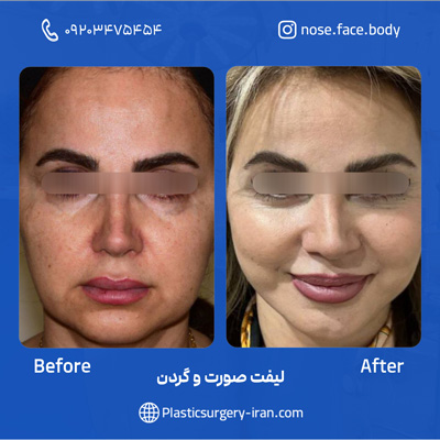 نمونه عمل لیفت صورت