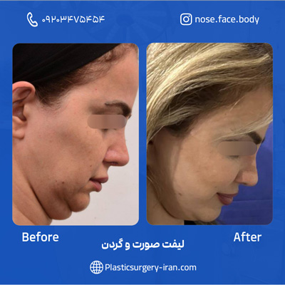 نمونه عمل لیفت صورت