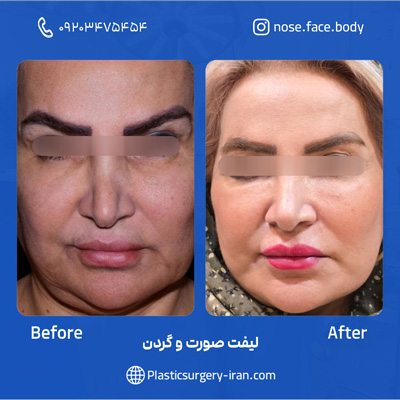نمونه قبل و بعد از لیفت صورت و گردن