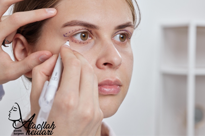 عمل لیفت شقیقه و بلفاروپلاستی با هم