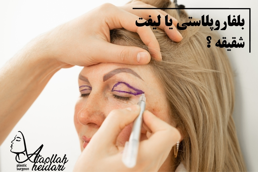 بلفاروپلاستی یا لیفت شقیقه کدام یک بهتر است