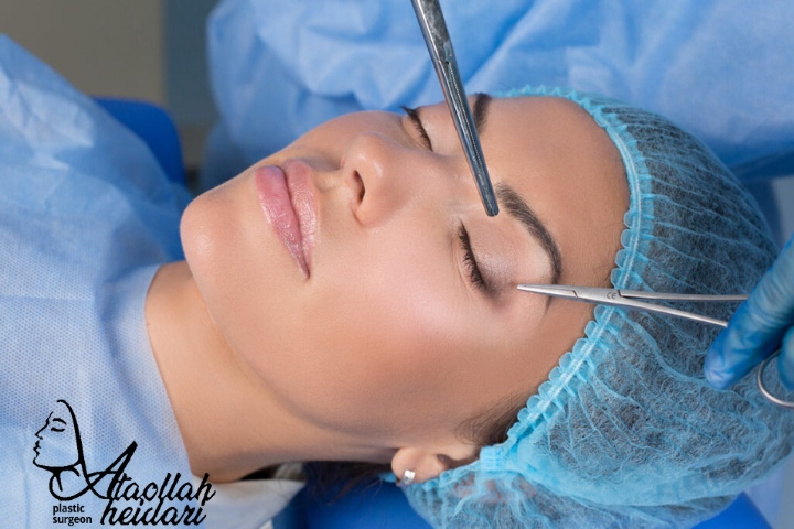 جای بخیه عمل لیفت ابرو