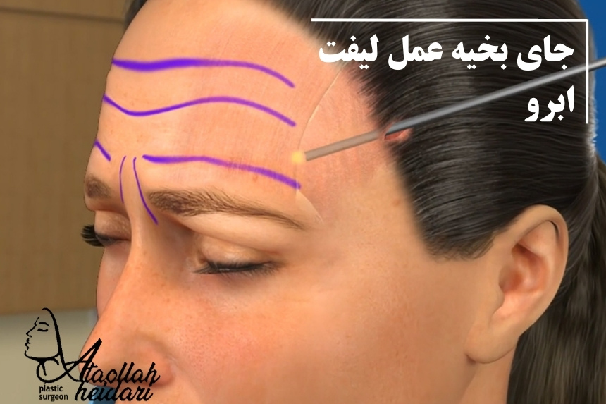 جای بخیه عمل لیفت ابرو