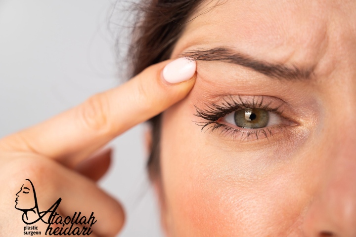 جای بخیه عمل لیفت ابرو