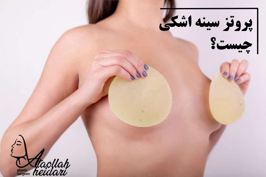 پروتز سينه مدل اشکی