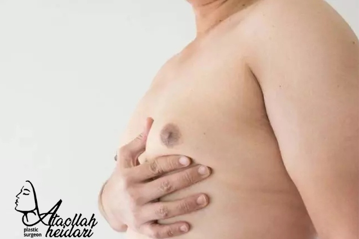 تفاوت ژنیکوماستی خفیف با ژنیکوماستی واقعی