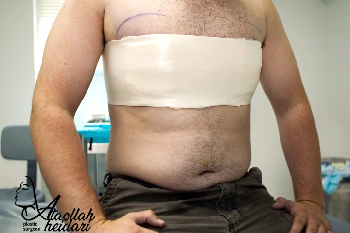 هزینه عمل ژنیکوماستی