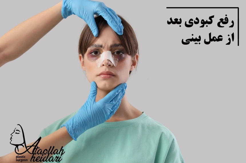 رفع کبودی بعد از عمل بینی