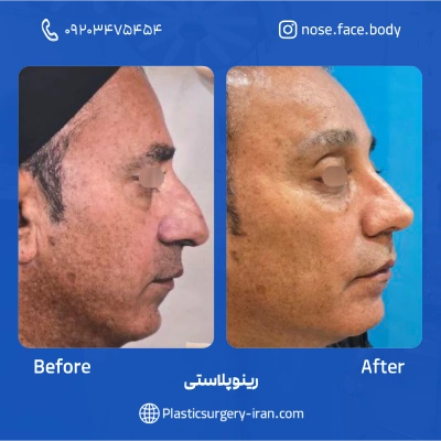 نمونه عمل بینی