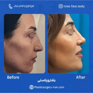 نمونه عمل بلفاروپلاستی