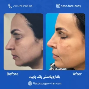 نمونه عمل بلفاروپلاستی