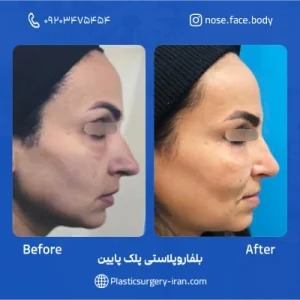 نمونه عمل بلفاروپلاستی