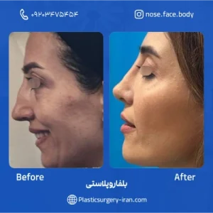 نمونه عمل بلفاروپلاستی