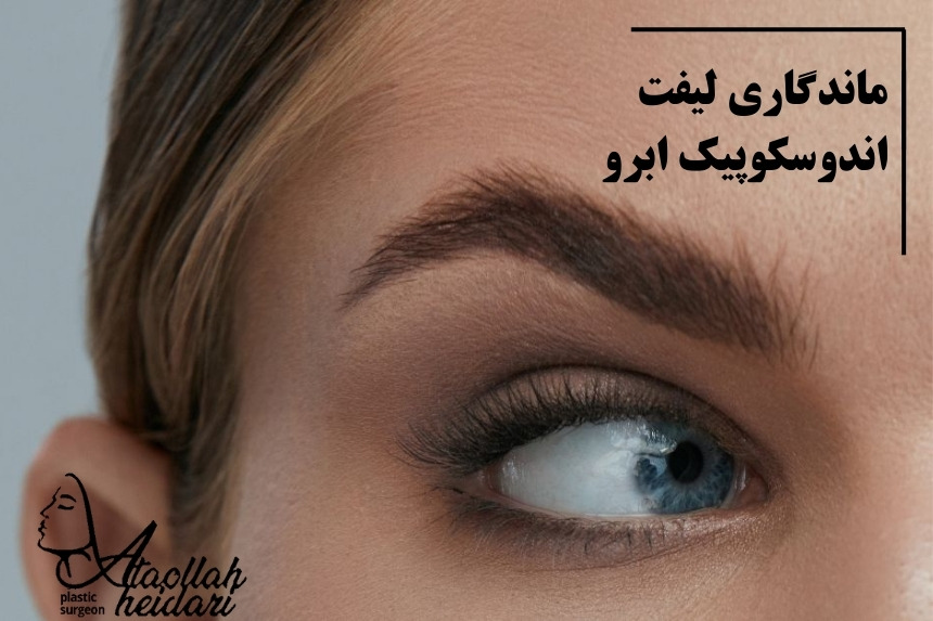 ماندگاری لیفت اندوسکوپیک ابرو