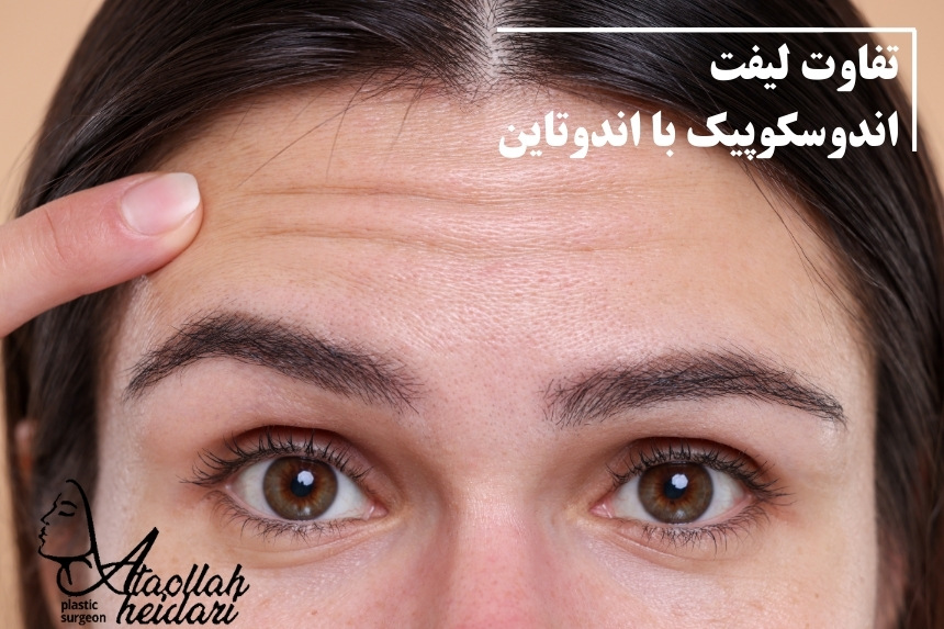 تفاوت لیفت اندوسکوپیک با اندوتاین