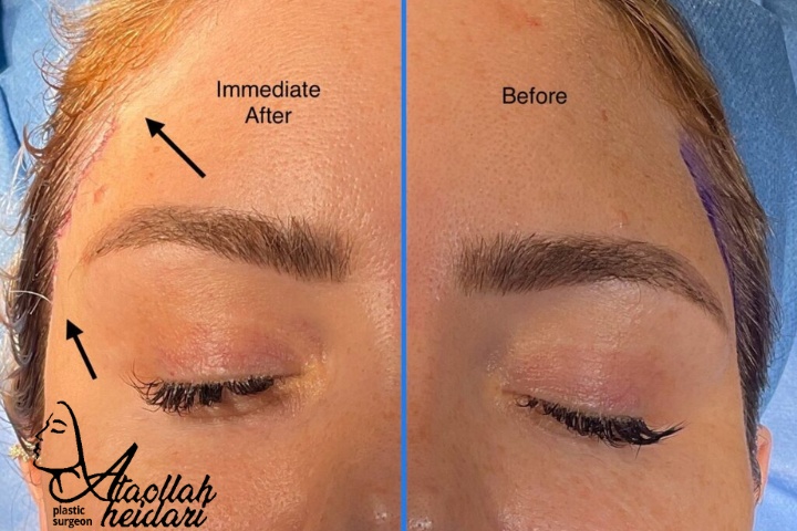 دوران نقاهت بعد از لیفت شقیقه اندوسکوپیک 