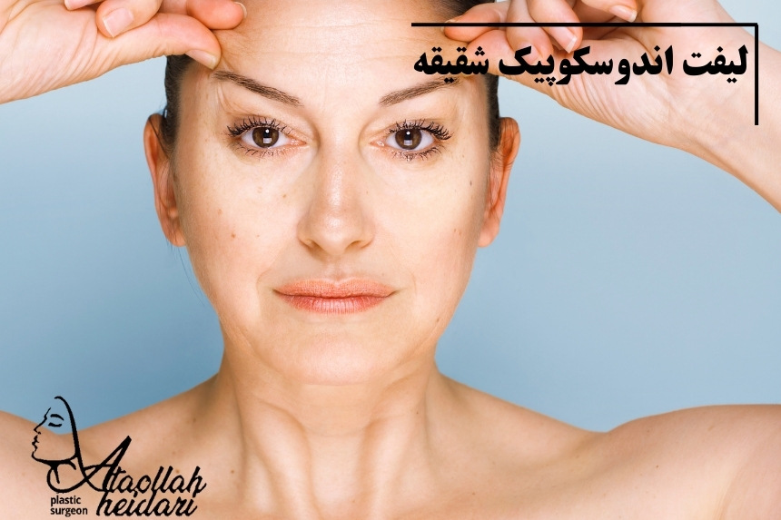 لیفت اندوسکوپیک شقیقه