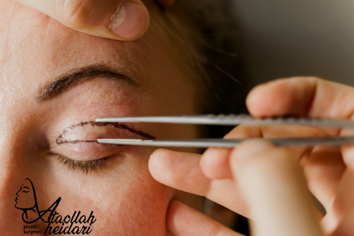 مراقبت های بعد از عمل بلفاروپلاستی