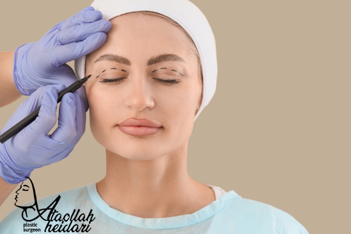 مراقبت های هفته دوم بعد از بلفاروپلاستی