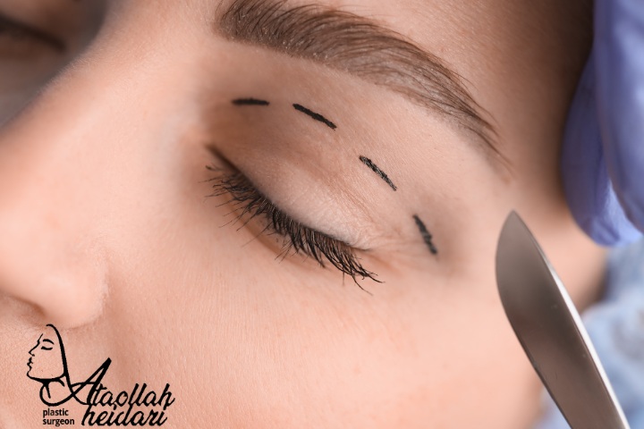 چه مدت بعد از بلفاروپلاستی میتوان به حمام رفت