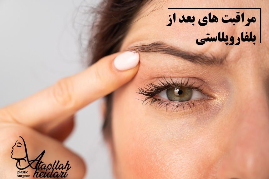 مراقبت های بعد از عمل بلفاروپلاستی