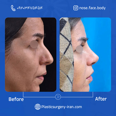 نمونه عمل بینی